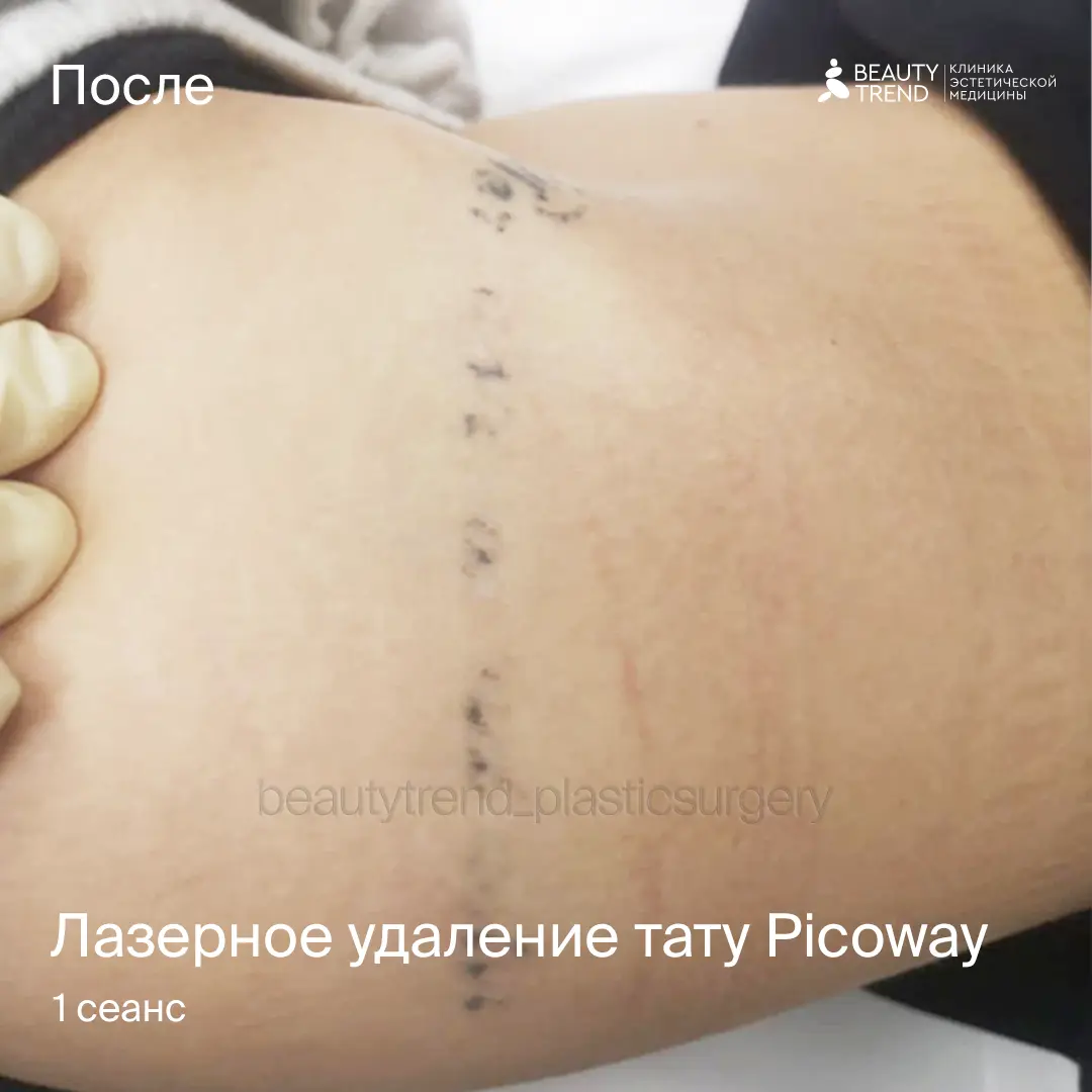 Удаление тату Picoway, 2С - после 1